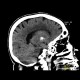 Calcification in basal ganglia: CT - Computed tomography